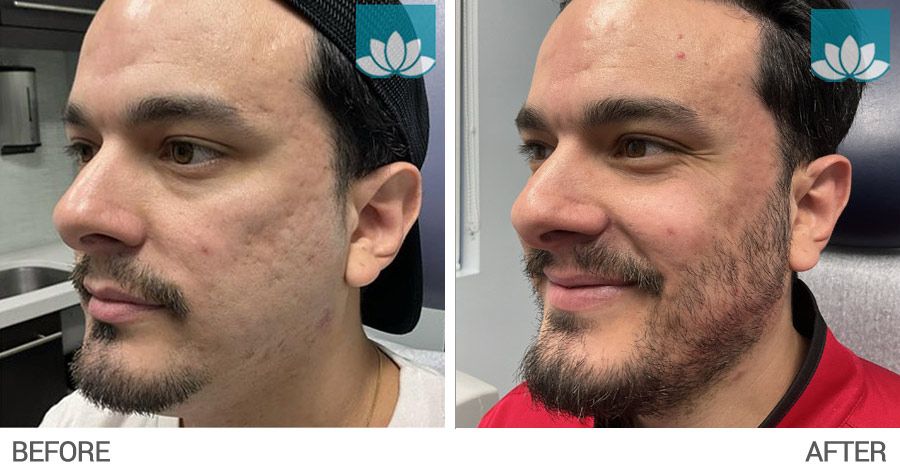 3 months post procedure with CO2.