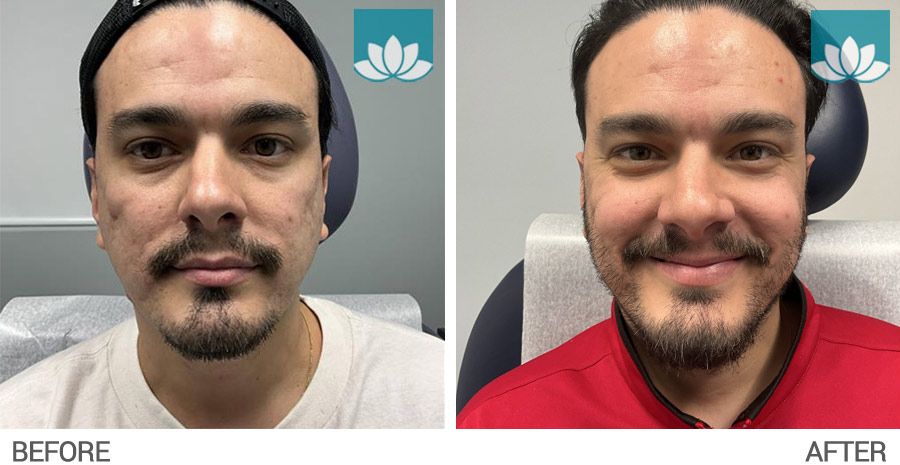 3 months post procedure with CO2.