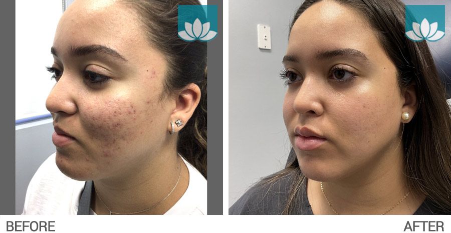 Before and after for patient with acne topical treatment.