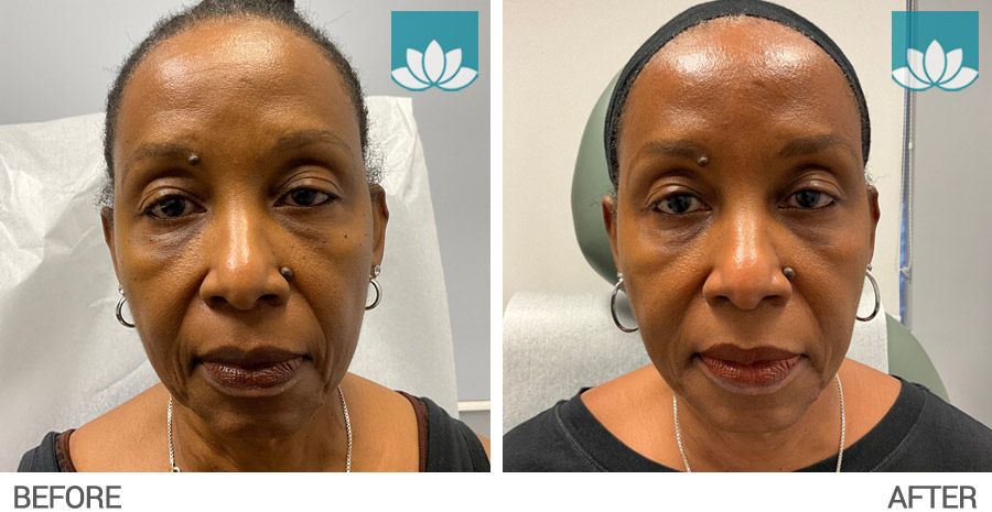 Before and after image with combination of treatments, filler, and neuromodulator.
