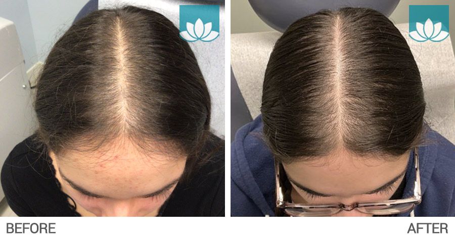 Hair loss treatment with Nutrafol.