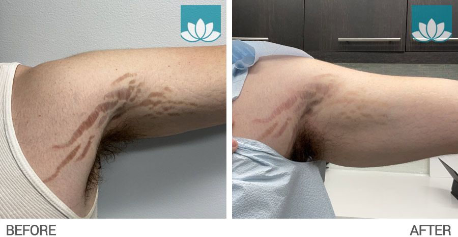 Patient treated with CO2 laser for stretch marks on the arm.