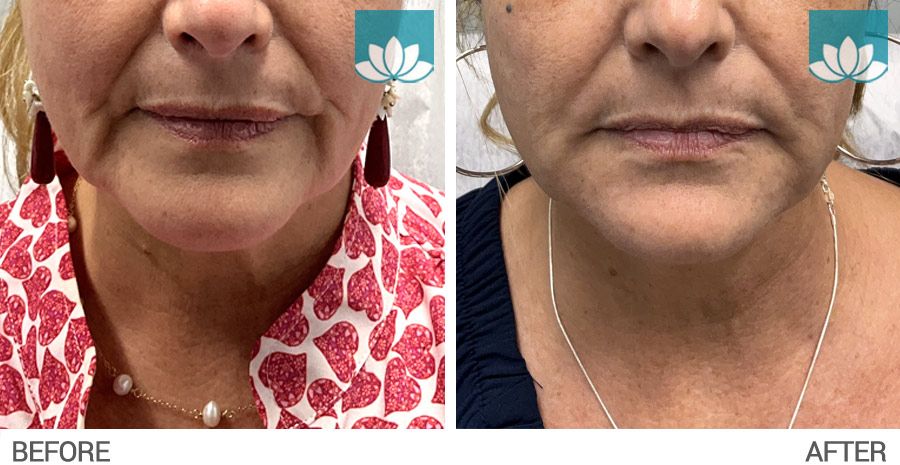 Patient treated with fillers at Sunset Dermatology.
