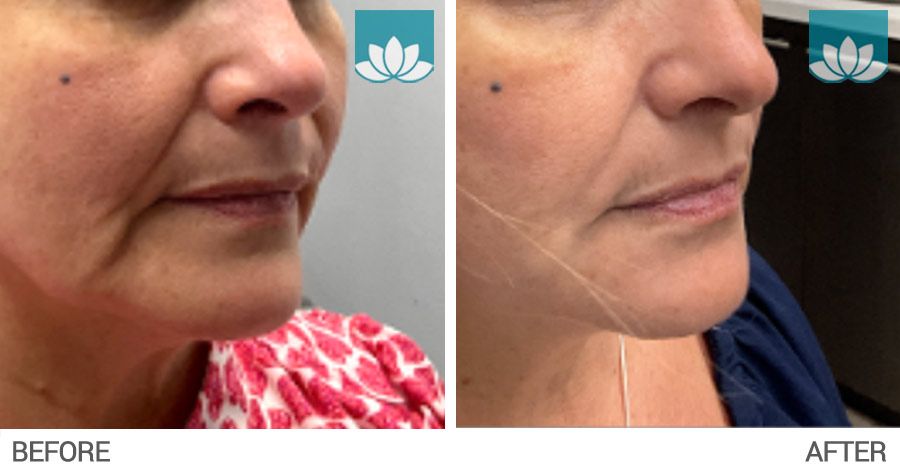 Patient treated with fillers.