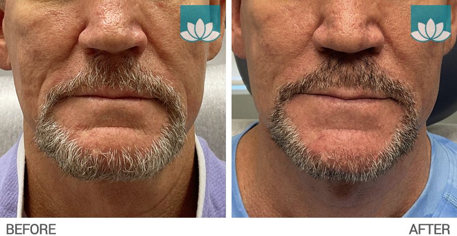 Fillers treatment in South Miami.