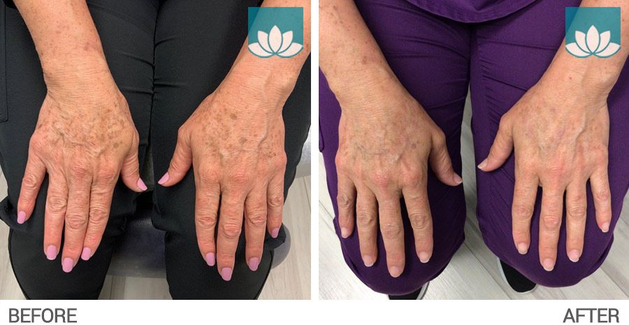 IPL and PicoWay treatment on hands in South Miami, FL.