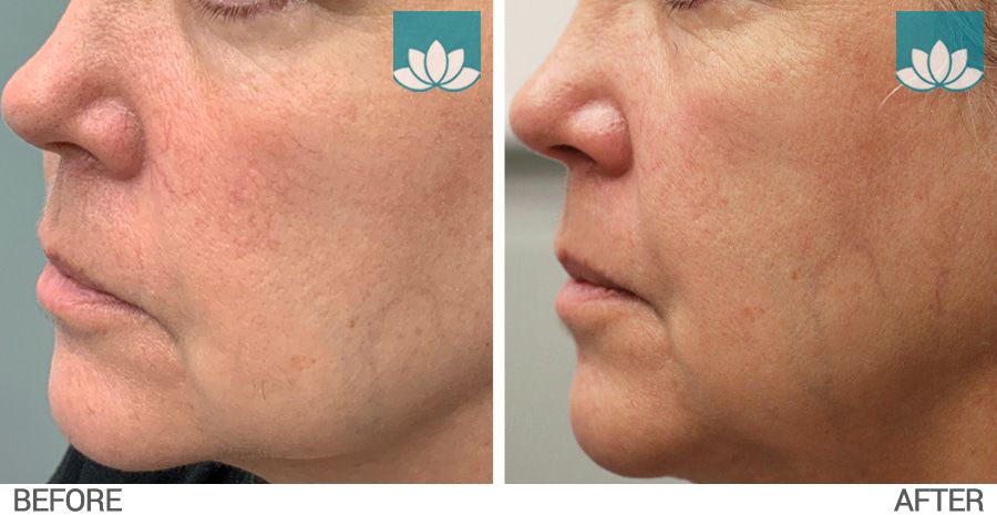 Facial telangiectasia treated with IPL before and after photo #2.