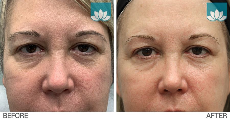 Facial telangiectasia treated with IPL before and after photo #1.