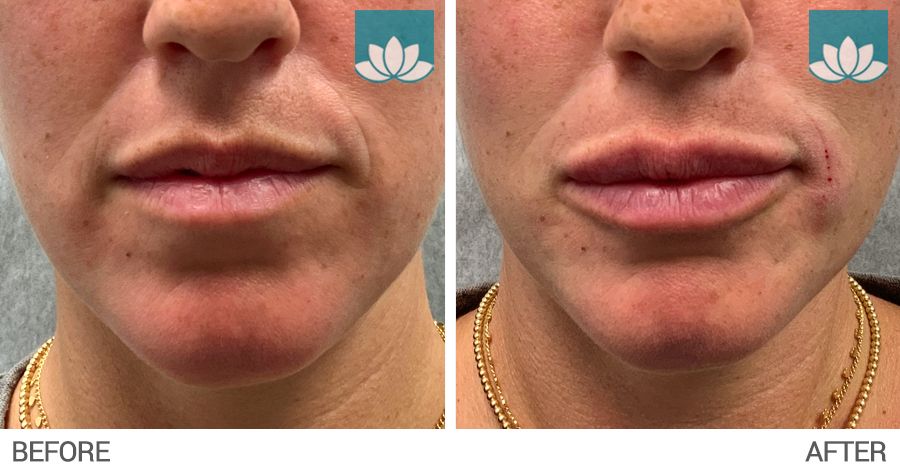 Lip augmentation performed at Sunset Dermatology, South Miami.