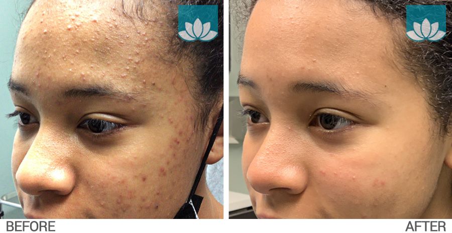 This patient treated for acne.
