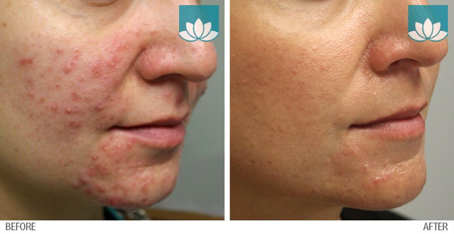 Before and after photos of patient treated for acne at Sunset Dermatology.