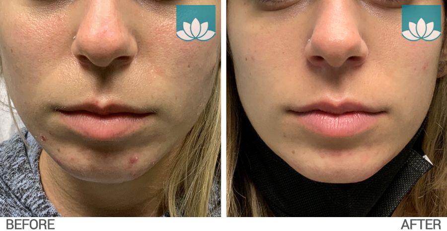 This patient treated for acne/rosacea.