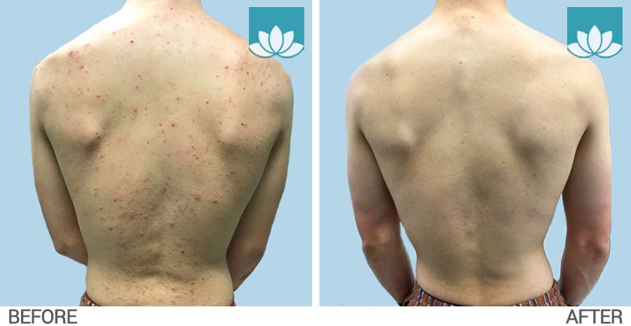 Before and after photos of paitent treated with Accutane for Acne on back. 