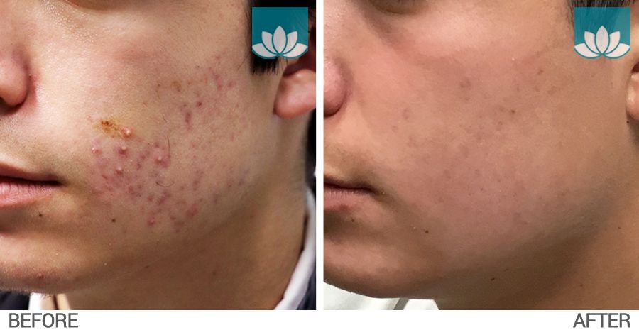Before and after photo of patient treated for acne with topical and oral medications.