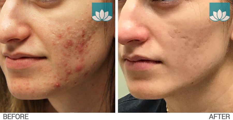 Before and after results of VBeam laser sessions and topical acne treatments at Sunset Dermatology. Photo #3.