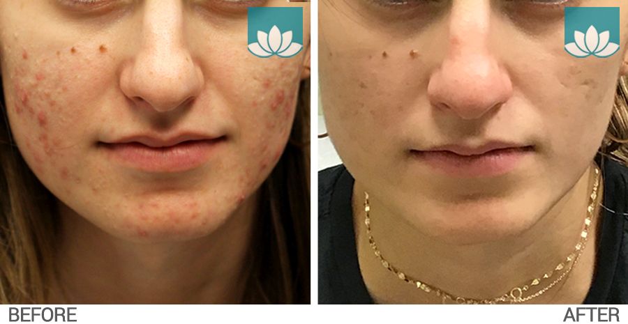Before and after results of VBeam laser sessions and topical acne treatments at Sunset Dermatology. Photo #1.