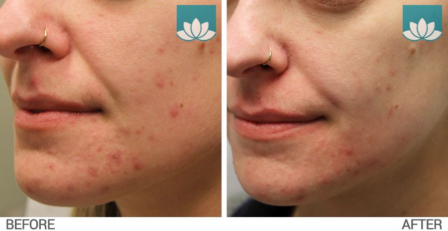 Before and after results obtained for acne treatment with topical and oral medications.
