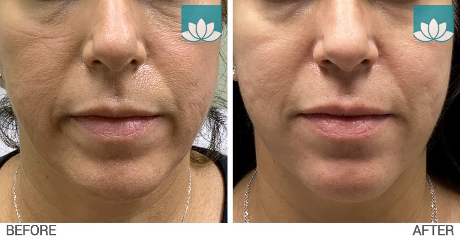 This patient had Belotero filler performed at lower face. Front view before and after image.