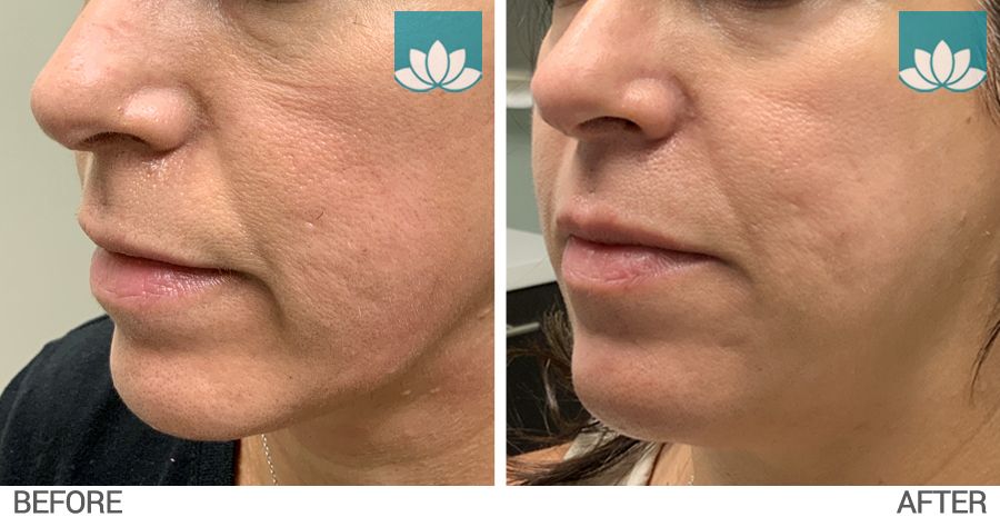 This patient had Belotero filler performed at lower face. Side view before and after image.