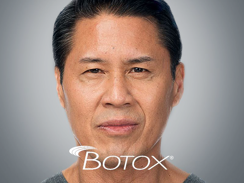 Botox discount in South Miami by Sunset Dermatology.