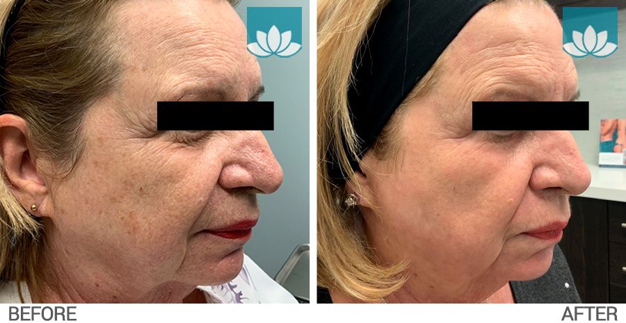 Results obtained after treatment with CO2RE laser.