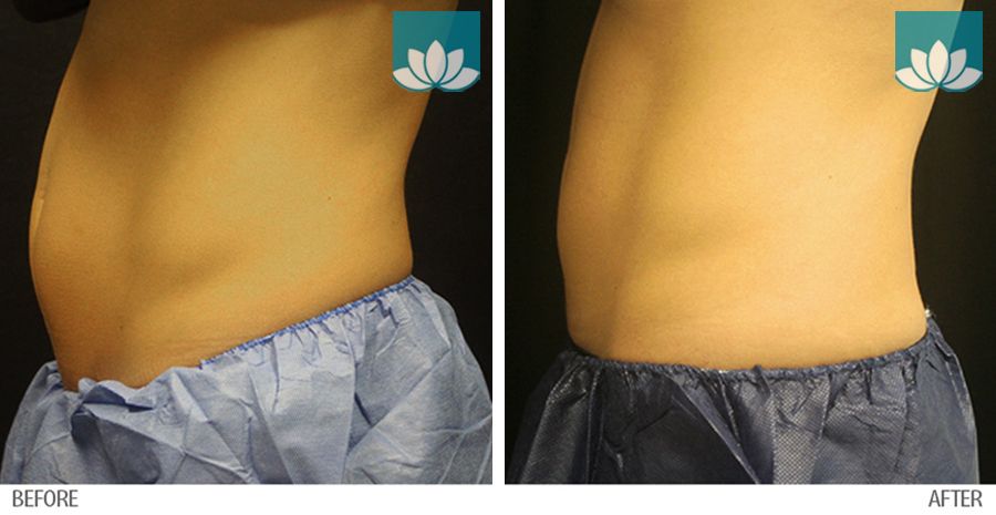Treatment of Coolsculpting in Miami, FL, by Sunset Dermatology.
