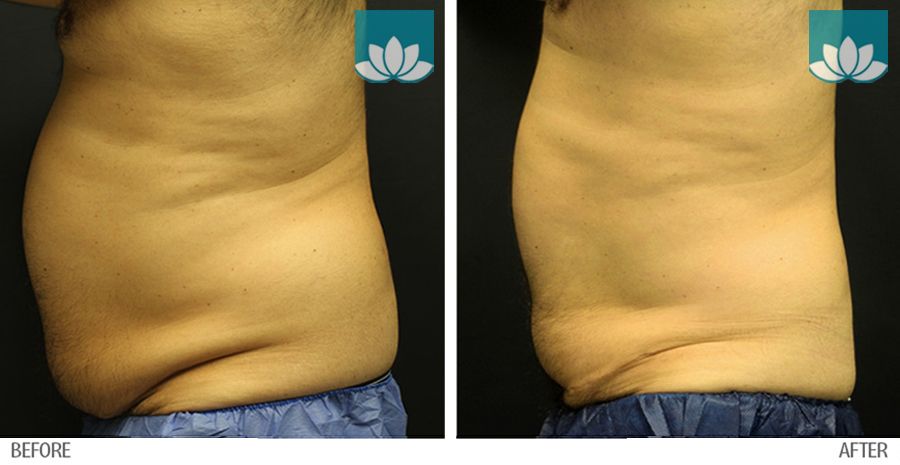 Treatment of CoolSculpting in Miami, FL, by Sunset Dermatology.
