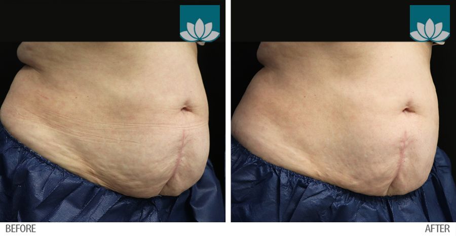Patient after treatment of Coolsculpting post one session 45 degree angle view.