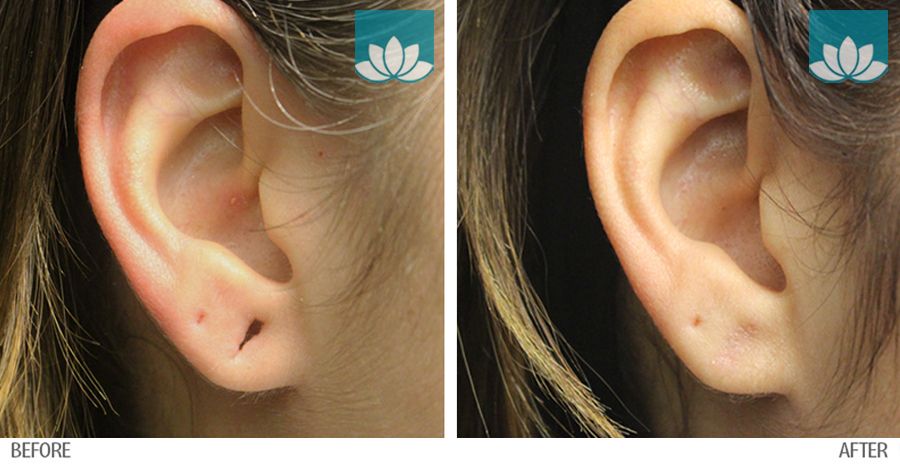 Ear repair surgery in Miami, FL, by Sunset Dermatology.