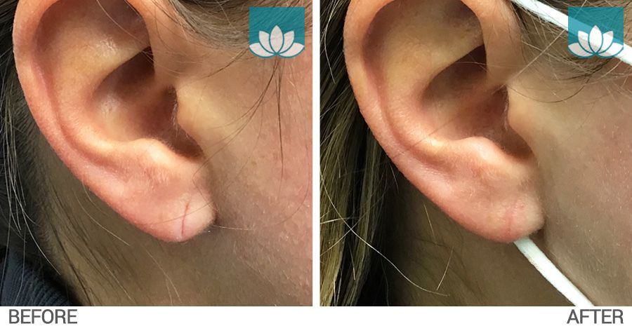 Ear repair surgery before and after photo at Sunset Dermatology in South Miami.