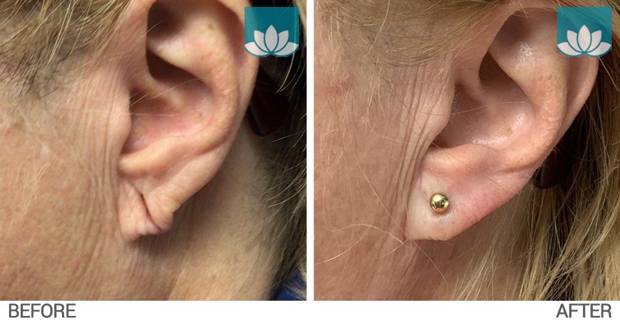Patient had ear repair surgery, Restylane filler and ear piercing performed. 