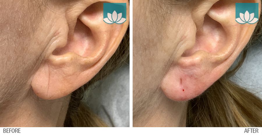 Patient had filler performed to her ear lobes with Restylane.