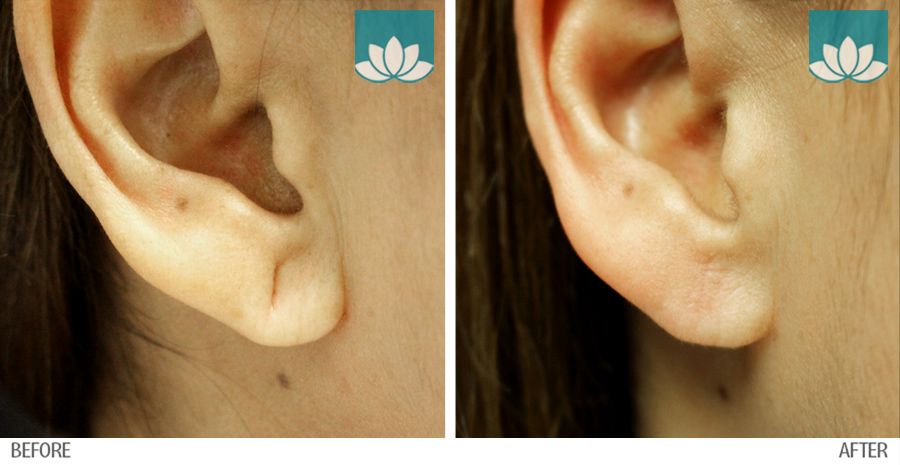 Ear repair surgery in South Miami, FL, by Sunset Dermatology.