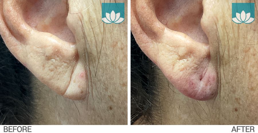 Patient ear lobe repair with fillers.