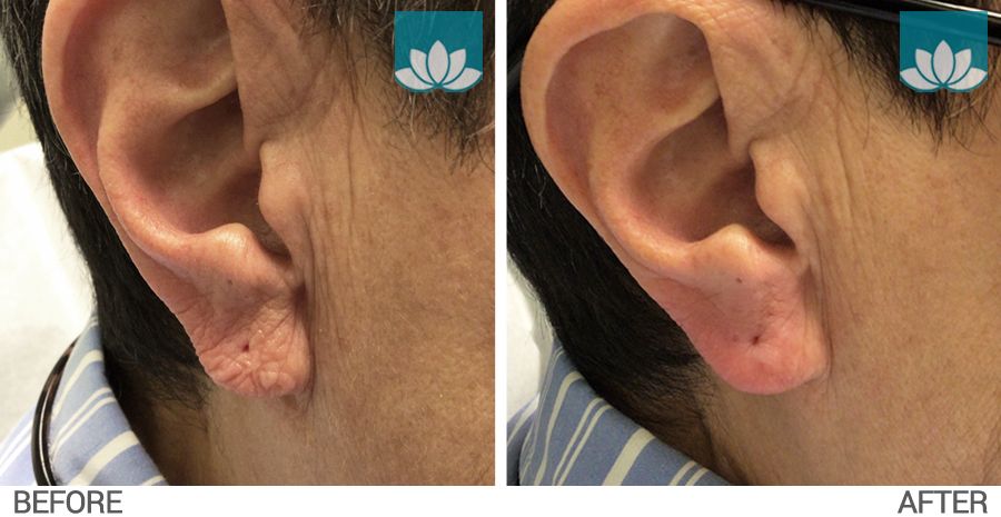 Ear lobes fillers by Sunset Dermatologist in South Miami Florida.