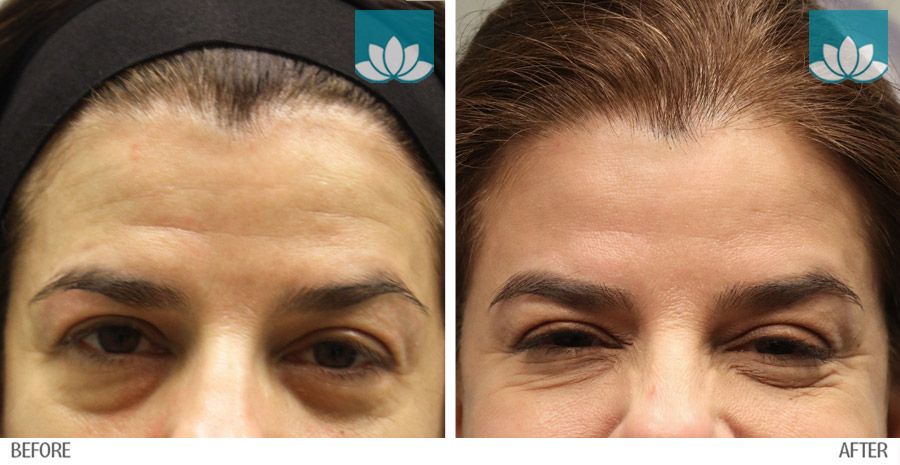 Patient results after treatment with neuromodulators and fillers.