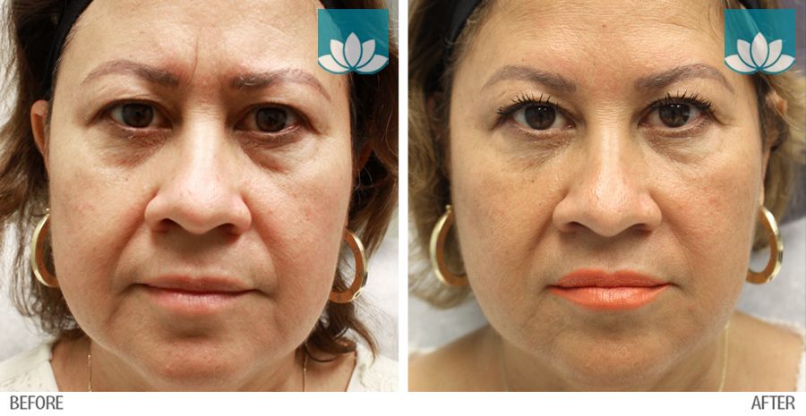 Patient treated with fillers at Sunset Dermatology. Before and after photo.