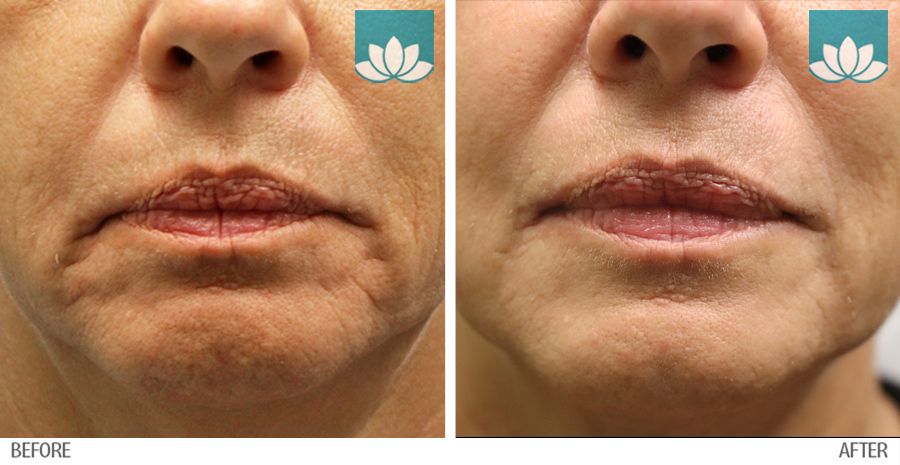 Before and After photos of Fillers treatment.