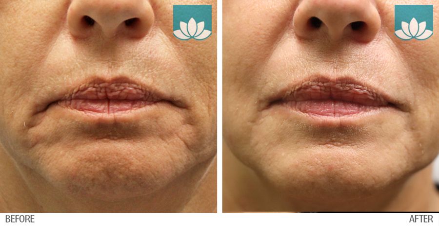 Patient treated with fillers before and after photo.