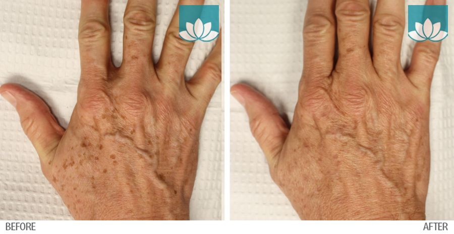 Before and After photos of patient hands treated with IPL at Sunset Dermatology.