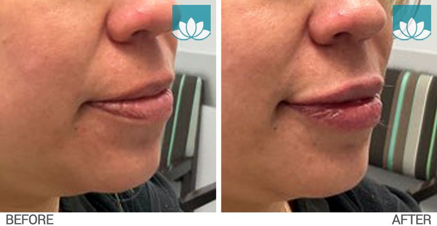 Lip augmentation results in Miami.