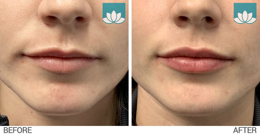 Lip augmentation at Sunset Dermatology in Miami, FL.