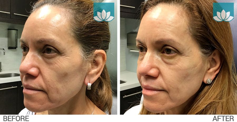 Before and after of a patient with melasma treated with Zo Medical Bleaching System.
