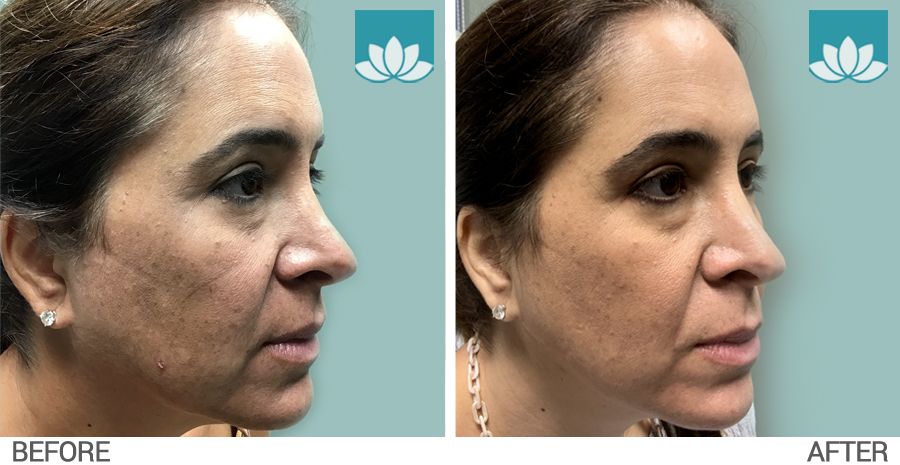 Patient with melasma treated with Zo Medical Bleaching System at Sunset Dermatology.