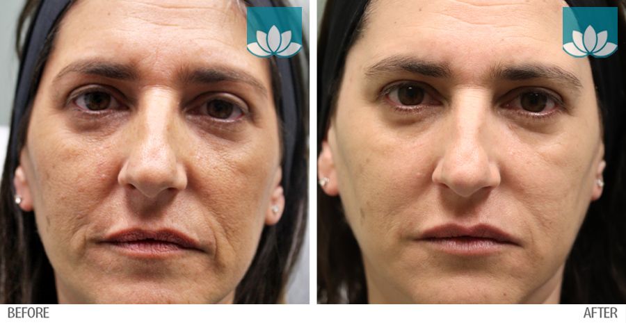 Before and after gallery of multiple procedures performed at Sunset Dermatology in South Miami.