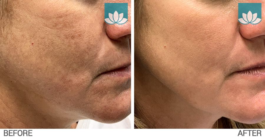 Before and after of patient with the VI Peel. 