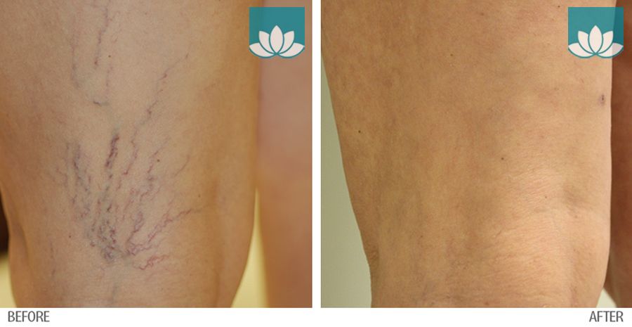 Treatment of Sclerotherapy in Miami, FL, by Sunset Dermatology.