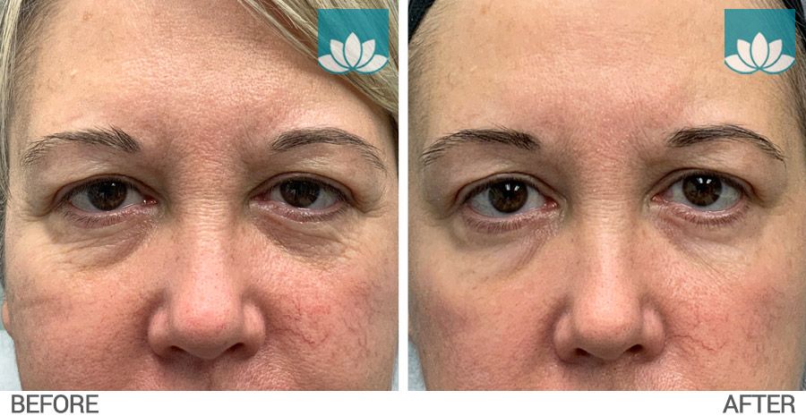 After one session of Ematrix performed around eyes results.