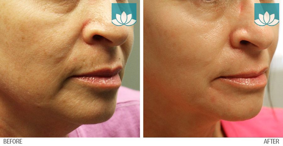 Before and after photo of  Post Various Filler Injections and Topical ZO Skin Health Regimen.