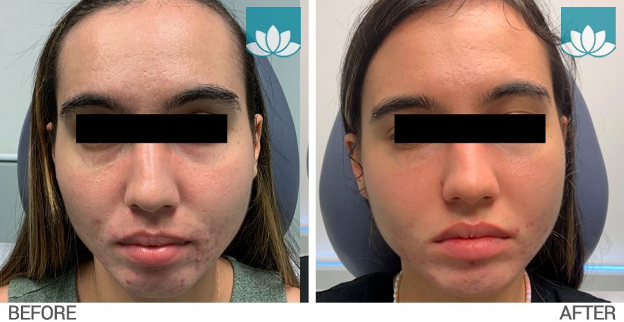 Before & after photo #1 of patient with the VI Peel.
